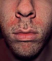 Seborrhoeic dermatitis on face